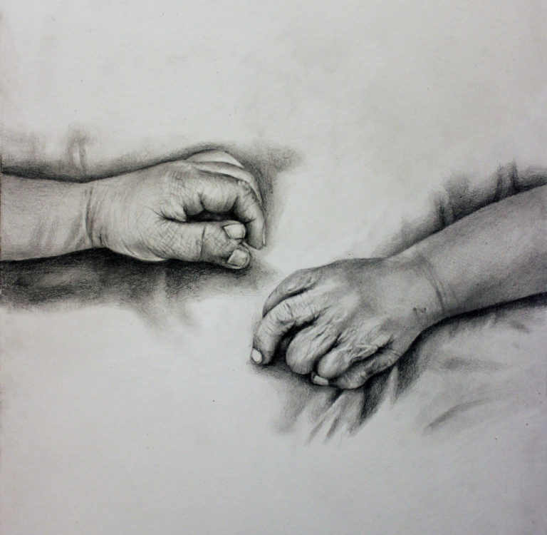 Polydactyly Reconstruction (left) and Debulking (right), Pencil